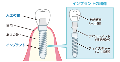歯の矯正 生命保険　対象になる歯の治療
